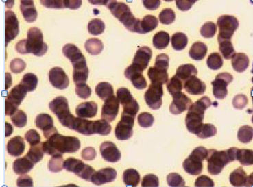 The Acute Phase Response Black Bile & Medieval Bleeding