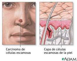CARCINOMA ESPINOCELULAR O DE CÉLULAS ESCAMOSAS (SCC)