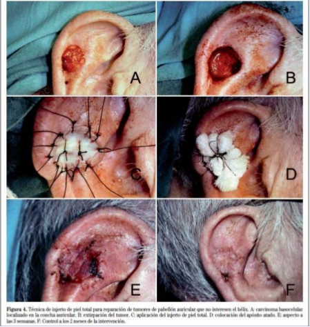 CARCINOMA ESPINOCELULAR O DE CÉLULAS ESCAMOSAS (SCC)