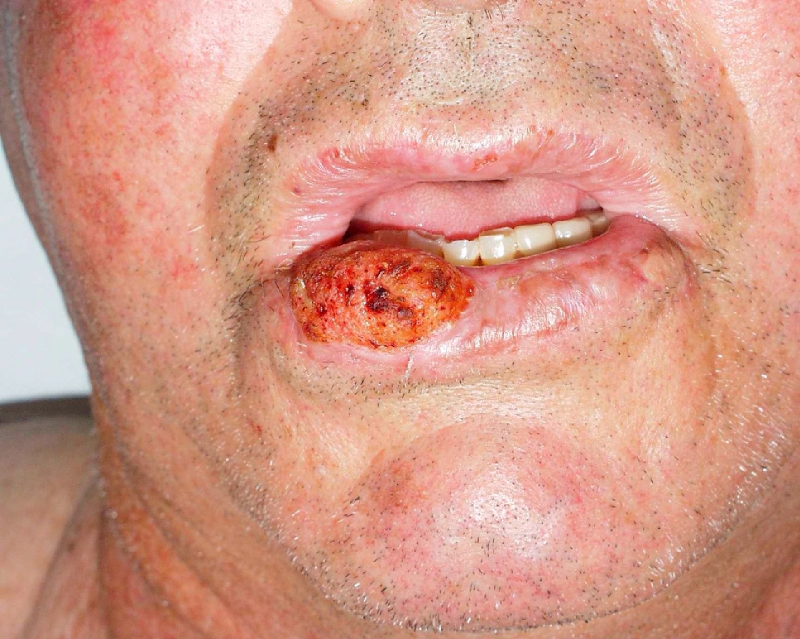 CARCINOMA ESPINOCELULAR O DE CÉLULAS ESCAMOSAS (SCC)