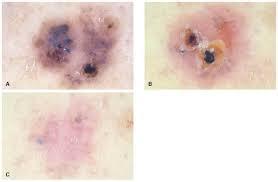 CARCINOMA ESPINOCELULAR O DE CÉLULAS ESCAMOSAS (SCC)