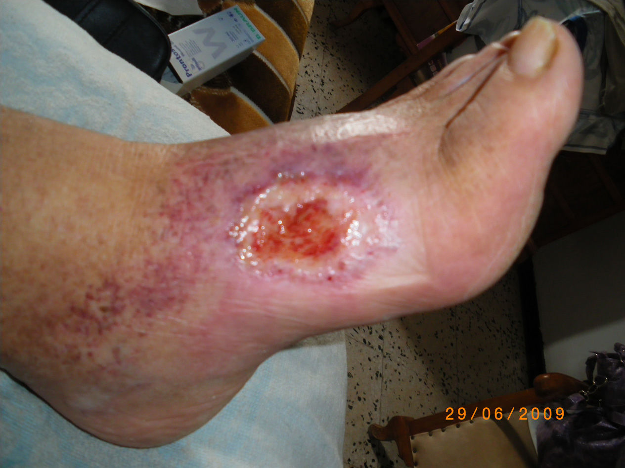 CARCINOMA ESPINOCELULAR O DE CÉLULAS ESCAMOSAS (SCC)