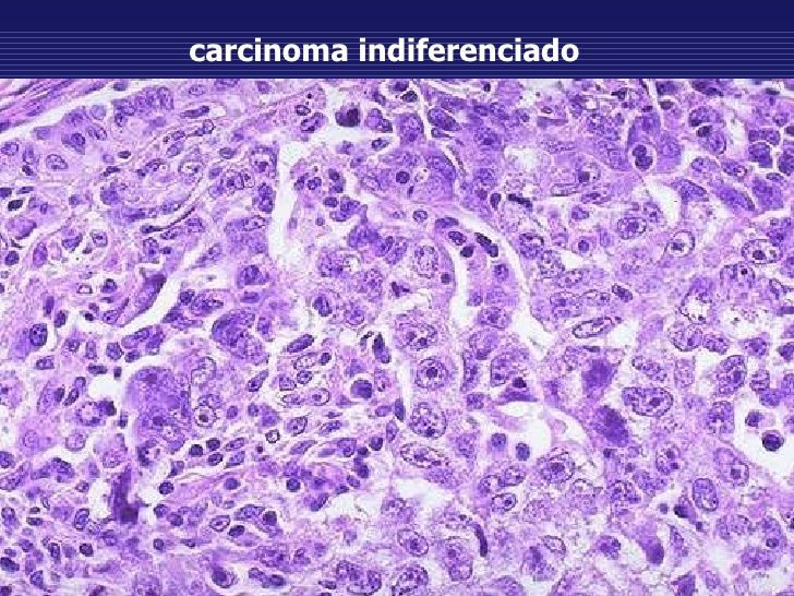 CARCINOMA ESPINOCELULAR O DE CÉLULAS ESCAMOSAS (SCC)