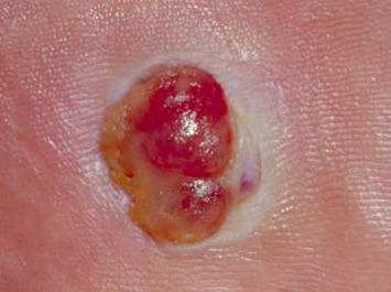 CARCINOMA ESPINOCELULAR O DE CÉLULAS ESCAMOSAS (SCC)