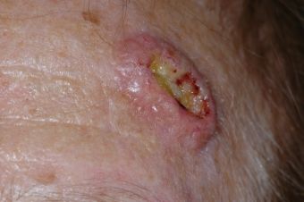 CARCINOMA ESPINOCELULAR O DE CÉLULAS ESCAMOSAS (SCC)