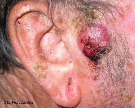 CARCINOMA ESPINOCELULAR O DE CÉLULAS ESCAMOSAS (SCC)