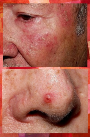 CARCINOMA ESPINOCELULAR O DE CÉLULAS ESCAMOSAS (SCC)