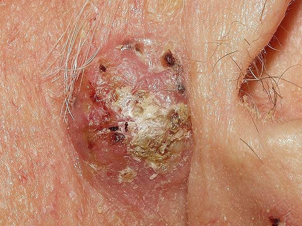 CARCINOMA ESPINOCELULAR O DE CÉLULAS ESCAMOSAS (SCC)
