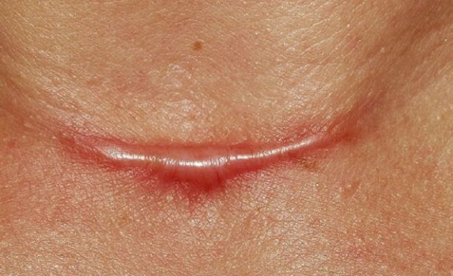 CARCINOMA ESPINOCELULAR O DE CÉLULAS ESCAMOSAS (SCC)