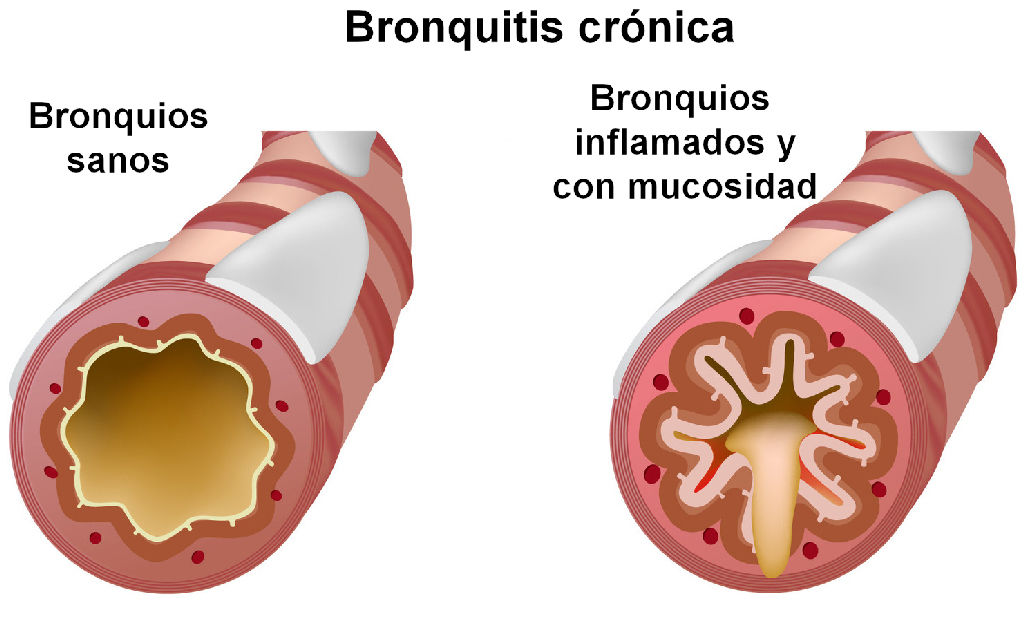 Bronquitis cronica