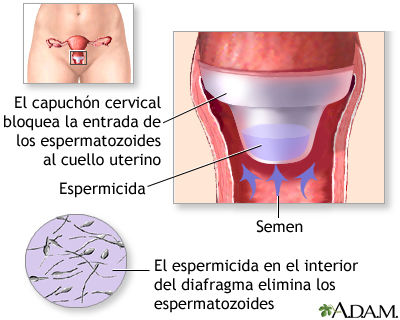 Capuchón cervical (Diafragma)