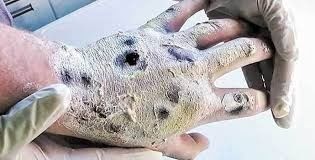 KROKODRIL Esta droga hace que la piel de un adicto se vuelva verde y escamosa y desigual como la de un cocodrilo.