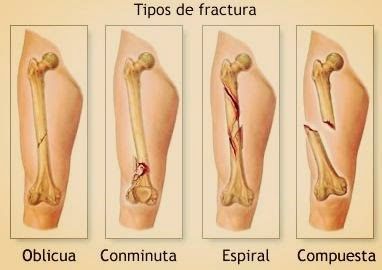 Fracturas Esguinces contucciones y luxaciones