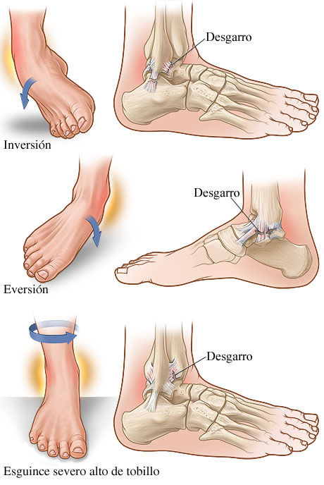Fracturas Esguinces contucciones y luxaciones