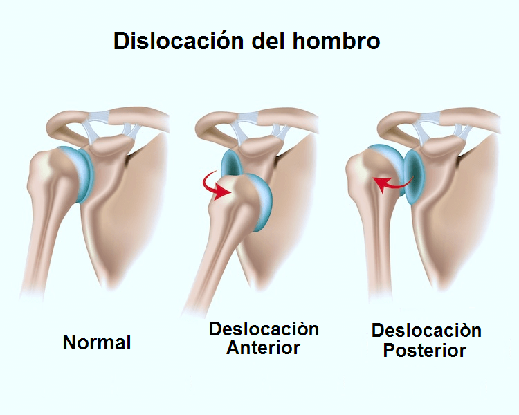 Fracturas Esguinces contucciones y luxaciones