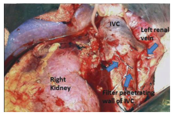 Insuficiencia arterial aguda, tromboflebitis, tombosis venosa profunda, compicaciones. Gerardo Cano Velázquez