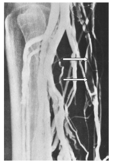 Insuficiencia arterial aguda, tromboflebitis, tombosis venosa profunda, compicaciones. Gerardo Cano Velázquez
