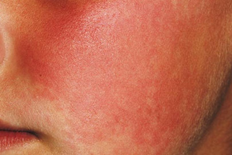 LESÕES ELEMENTARES DA PELE - CLÍNICA MÉDICA II DERMATOLOGIA