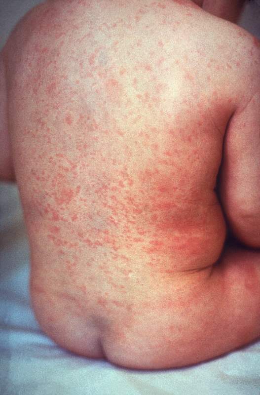 EXANTEMA