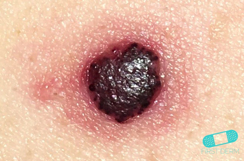 ANGIOMA