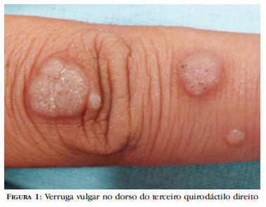 VERRUCOSIDADE