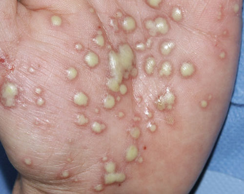 PÚSTULA