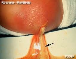 ABSCESSO