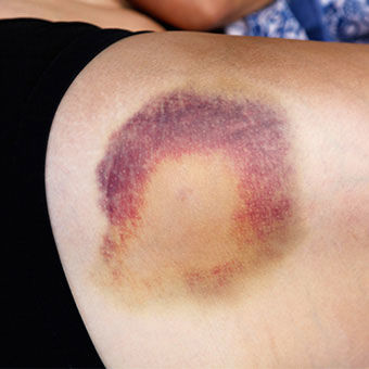 HEMATOMA