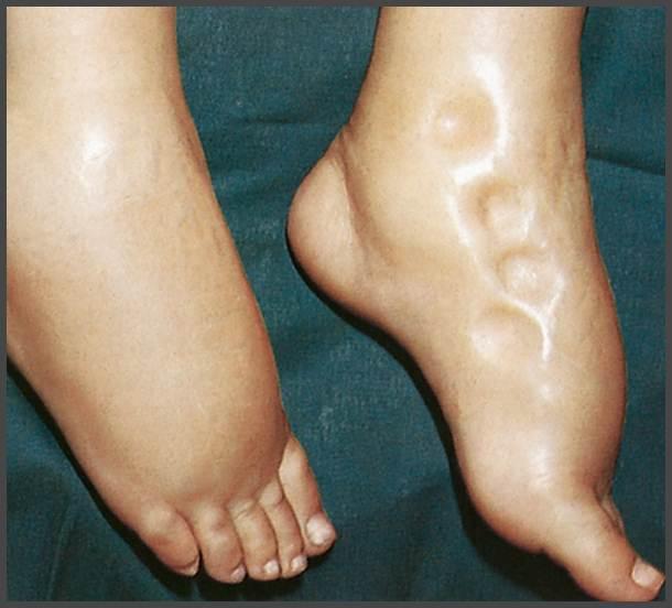 EDEMA