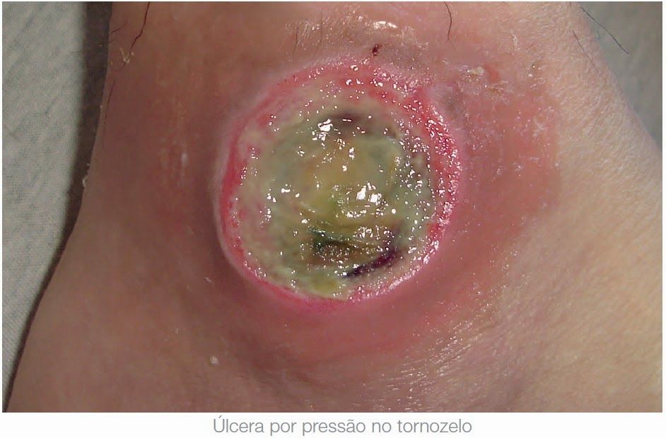 ÚLCERA