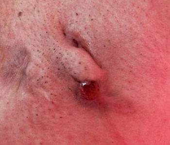 FÍSTULA