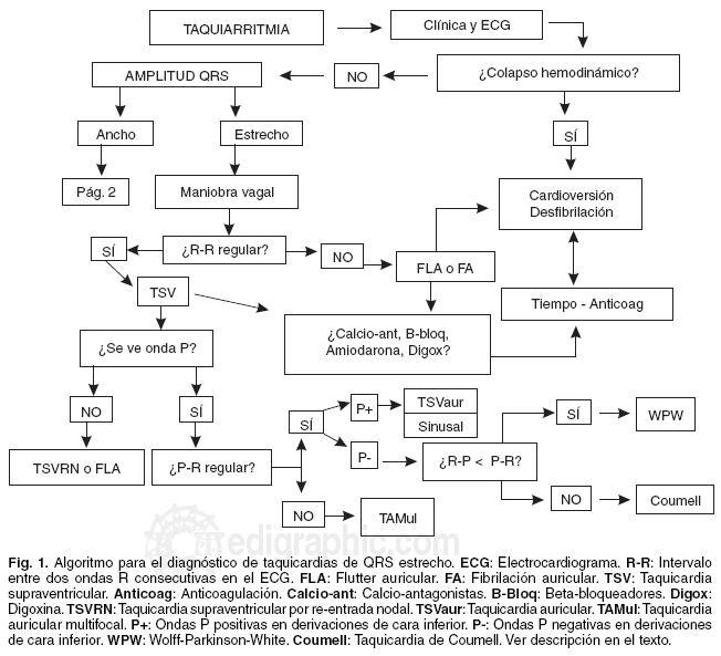 Diagrama Taquiarritmia