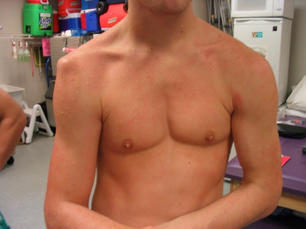 Shoulder dislocation A hard blow can knock the shoulder out of place. This is very painful. Hips can also be dislocated.