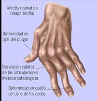 Reumatologica: Es una especialidad de la Fisioterapia dedicada a aliviar el dolor de los trastornos del aparato locomotor y del tejido co...