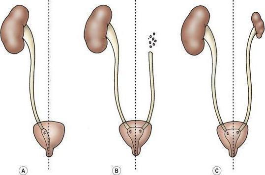 Aplasia