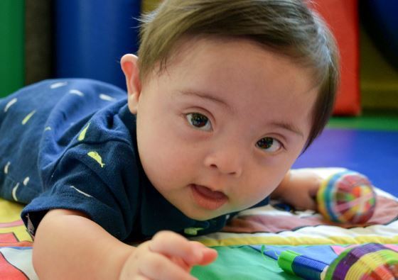 Puente Nasal Plano Aplanamiento de los huesos del puente nasal *Sx. Down *Acondroplasia *Blefarofimosis *Sx. Hurler