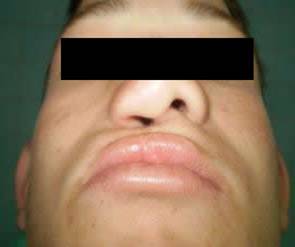 Septum Nasal Ausente Ausencia del cartílago del tabique nasal *Holoprosencefalia