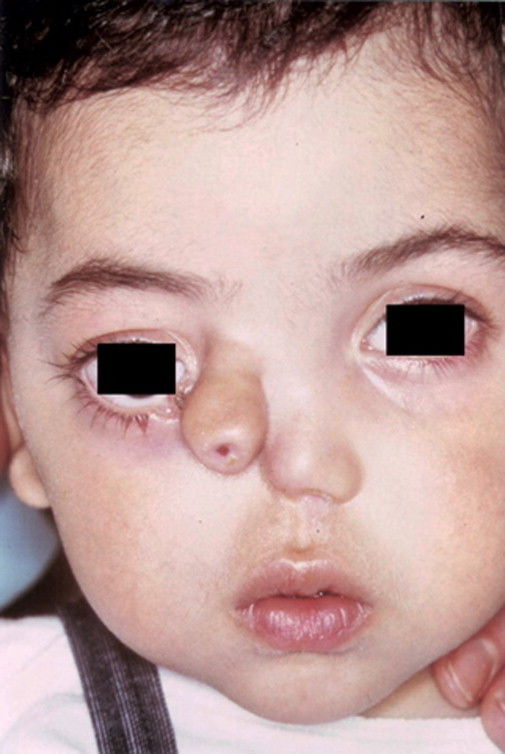 Duplicación Nasal Existencia de 2 narices en un individuo o más de 2 fosas nasales *Displasia frontonasal
