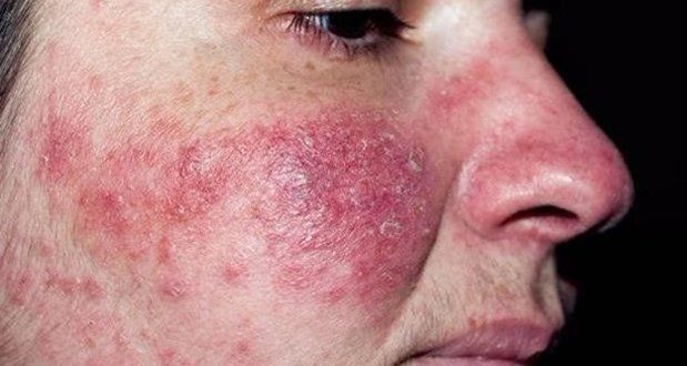 Acné Rosácea Piel color rosada, presenta úlceras con apariencia de acne