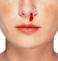 Epistaxis Espontánea Rinorragia. Hemorragia nasal sin razón aparente