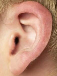 Pabellones Auriculares Engrosados Cartílago del pabellon aricular hipertrófico, ensanchado y con bordes toscos *Sx. Beare-Stevenson