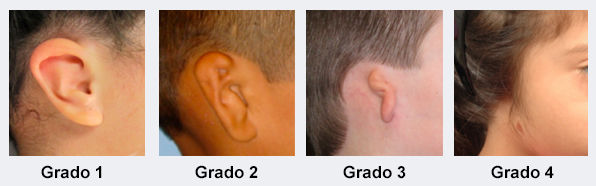 Microtia tipo ll Oreja pequeña con algunas alteraciones de morfología sin perder la oreja Puede o no tener conducto auditivo *Sx. Primer ...