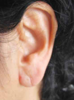 Oreja Colgante Hélix y lóbulo de la oreja caidos