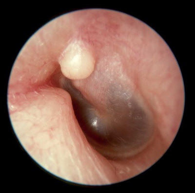Exostosis Auriculares Crecimiento óseo del conducto externo que llega a obstruir la luz