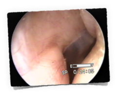 Excondrosis Auricular Crecimiento cartilaginoso que obstruye el conducto auditivo externo