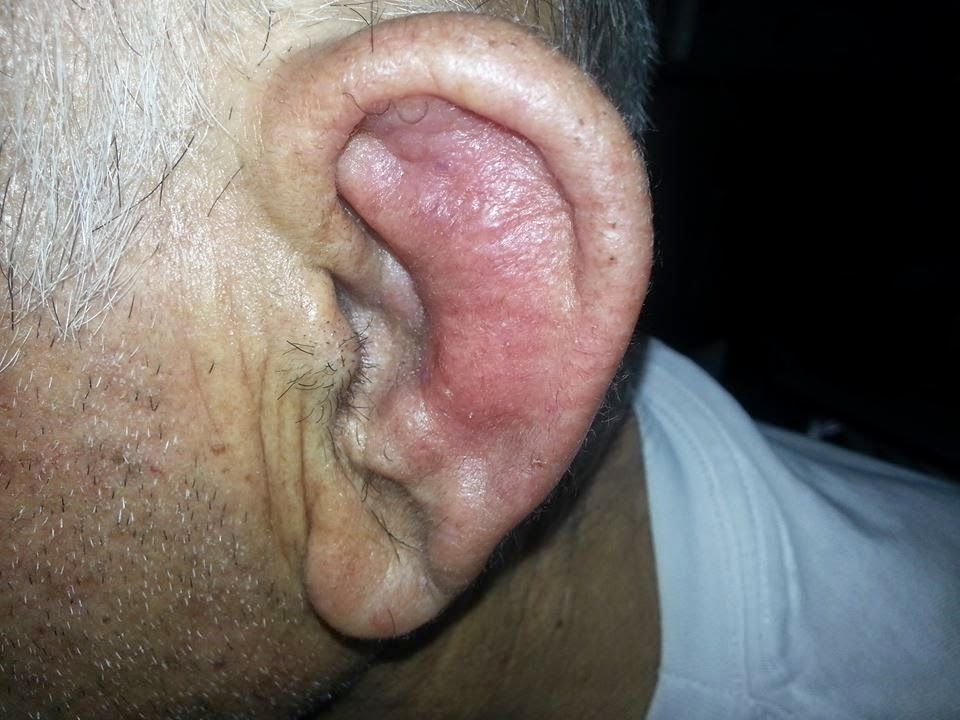 Oreja Calcificada Calcificación de los cartilagos auriculares