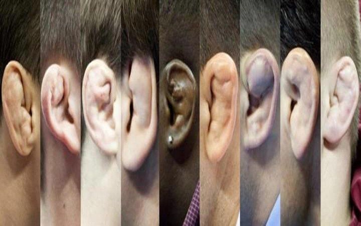 Oreja Arrugada (de lucha) Plegamiento sobre sí mismo que da la apariencia de arrugas *Displasia diastrófica