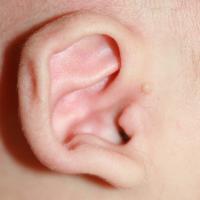 Coloboma de Hélix Fisura o hendidura en el hélix por cierre incompleto del cartílago auricular