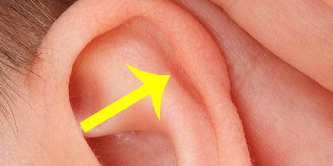 Tuberculo Darwiniano Saliente del hélix por debajo de la curvatura superior