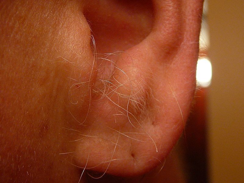 Hipertricosis Auricular Presencia de vello en el pabellón auricular *Calvicie